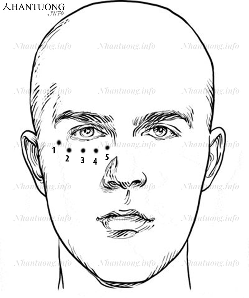 Một số vị trí phổ biến nốt ruồi mọc dưới mắt phải của nam giới